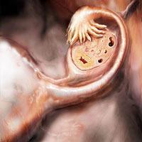 Эмбриональная киста широкой связки матки