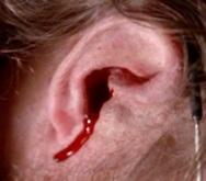 Кровотечение из уха