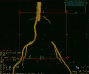 Тромбоэмболия левой общей подвздошной артерии в устье отхождения от аорты