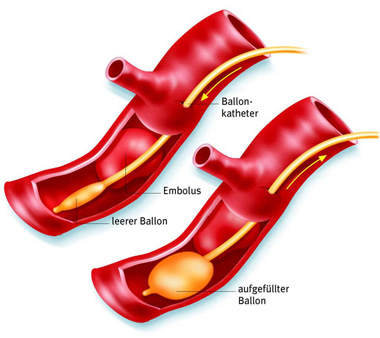 Непрямая тромбэктомия зондом Фогарти при остром тромбозе (эмболии) артерий конечности