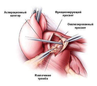 Прямая тромбэктомия при остром тромбозе (эмболии) артерий конечности