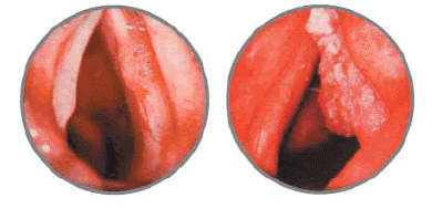 Злокачественное новообразование гортани