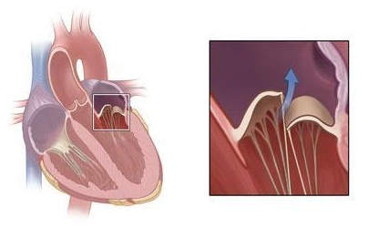 Хроническая ревматическая болезнь сердца