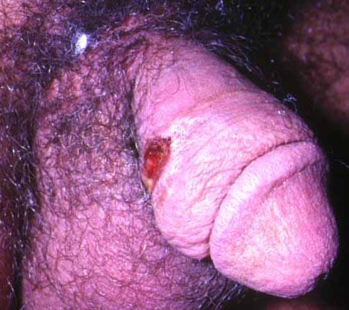высыпания первичного сифилиса на половом члене