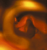 Врожденный стридор гортани