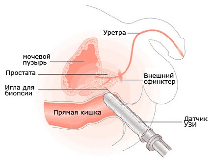 Лечение простатит в урумчи