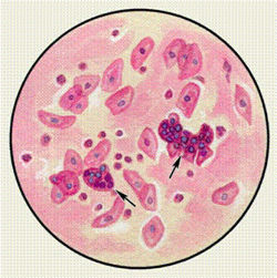 Атипичные клетки в мокроте при пневмонии thumbnail