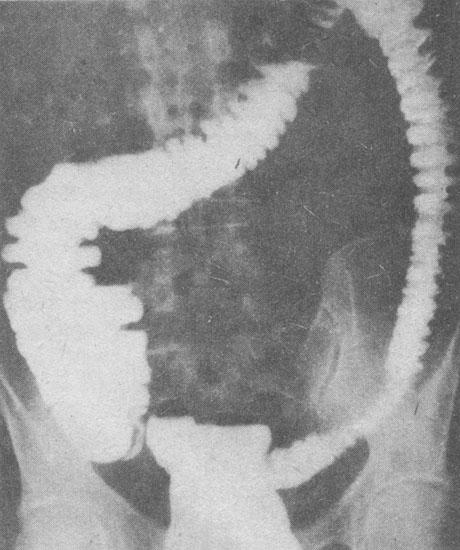 Рентгенологическое исследование толстой кишки