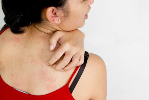 Аллергия на пыль на коже