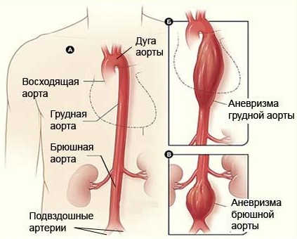 Аорта при аневризме грудного и брюшного отдела аорты
