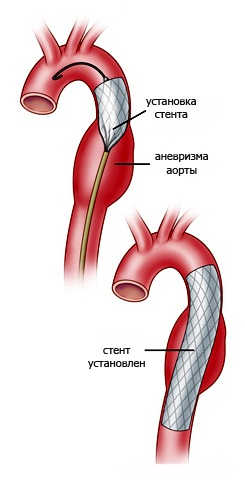 Установка стент-графта при аневризме брюшного отдела аорты