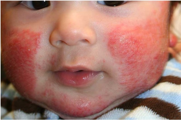 Атопический дерматит у детей: фото
