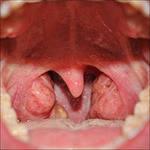 Доброкачественные новообразования рта и глотки