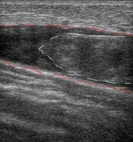 Выявленный тромб в просвете бедренной вены по данным дуплексного сканирования при флеботромбозе