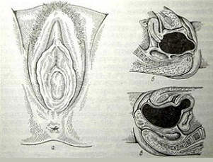 Девственная плева, полностью закрывающая вход во влагалище (hymen imperforatus)