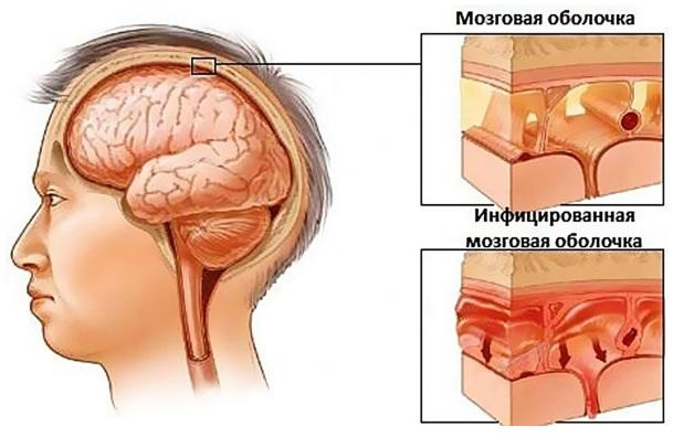 Воспаление оболочек мозга при менингите