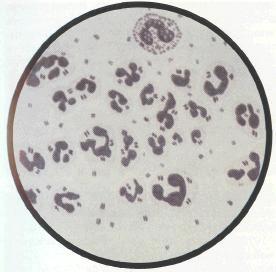 Эпидемический цереброспинальный (менингококковый) менингит
