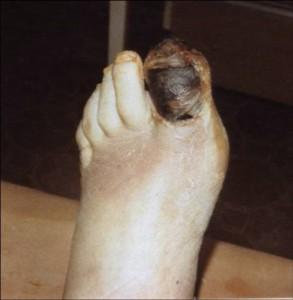 Некроз 1-го пальца стопы при облитерирующем атеросклерозе (4-я степень заболевания)