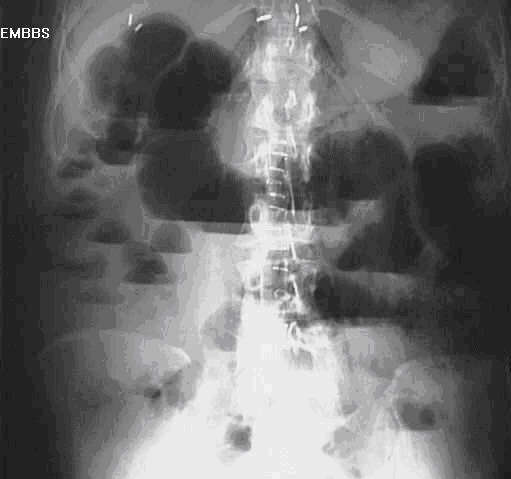 Рентгенологическая картина при кишечной непроходимости