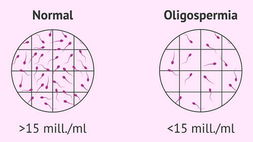 Сперма при олигоспермии