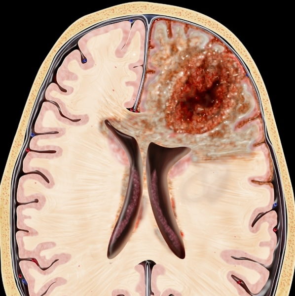 Опухоль центральной нервной системы (ЦНС)