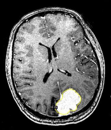 МРТ головного мозга при парасагиттальной менингиоме