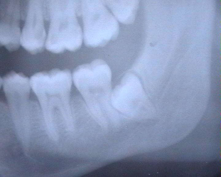 Прицельная рентгенография угла нижней челюсти; ретинированный 8 зуб