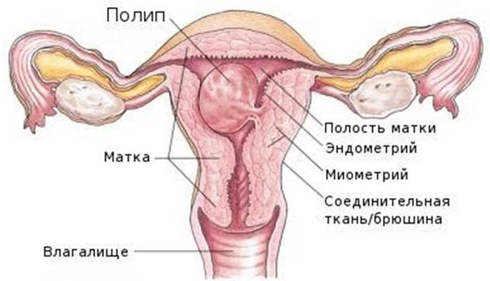 Полип тела матки и цервикального канала