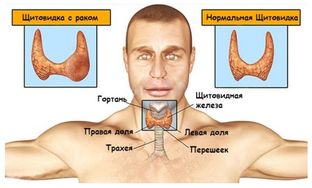 Рак щитовидки