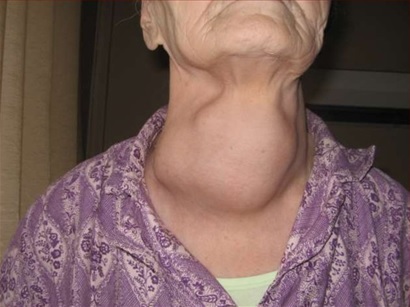 Рак щитовидной железы: фото