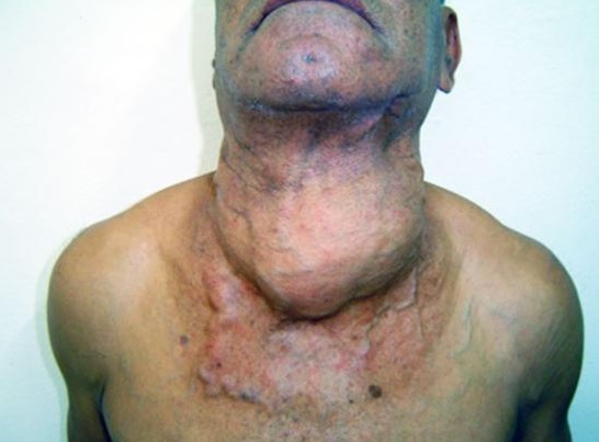 Рак щитовидной железы у мужчин: фото