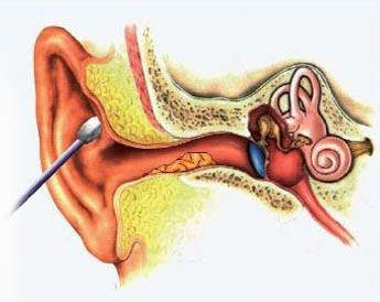 Правильное использование ватных палочек с целью гигиены наружного уха