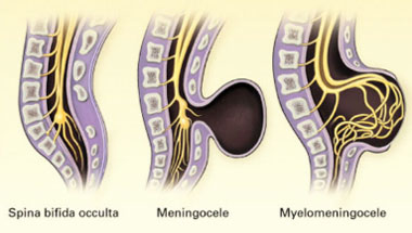 Спина бифида (spina bifida occulta)
