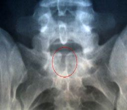 Рентгенография пояснично-крестцового отдела позвоночника при спина бифида