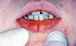 Хроническая трещина губы