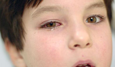 Конъюнктивит и боль в глазных яблоках при болезни Зика