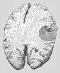 Злокачественные новообразования оболочек головного мозга