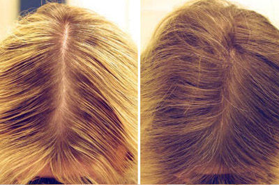 До и после мезотерапии для волос