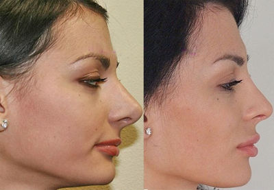 Ринопластика (пластика носа): фото до и после