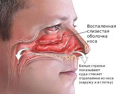 Заложенность носа, насморк: описание симптома
