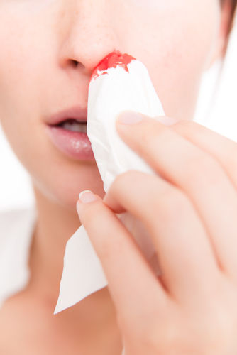 Носовые кровотечения: описание симптома