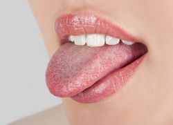 Жжение, сухость в полости рта: описание симптома