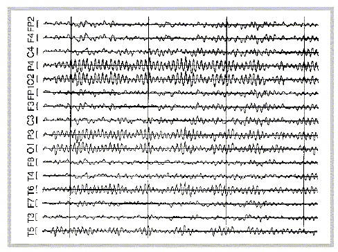 Мониторинг сна в омске. eeg. Мониторинг сна в омске фото. Мониторинг сна в омске-eeg. картинка Мониторинг сна в омске. картинка eeg. Сомнология – раздел медицины и нейробиологии, посвящённый исследованиям сна, расстройств сна, их лечению и влиянию на здоровье человека. На сегодняшний день это одна из наиболее динамично развивающихся медицинских специальностей.
